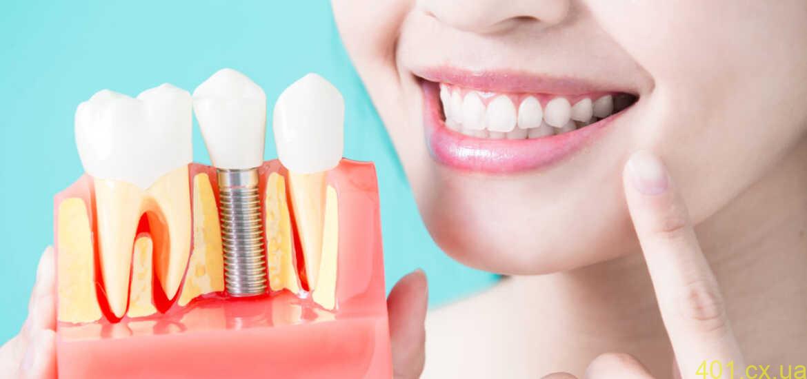 Імплантація зубів та її особливості